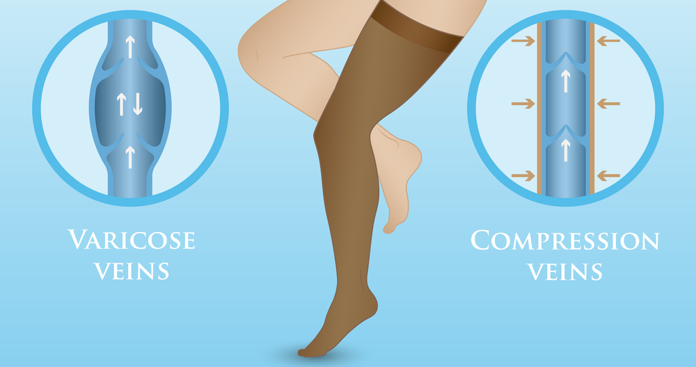 Bas de Contention : Comment Ça Marche et Quels Bienfaits ? - my contention